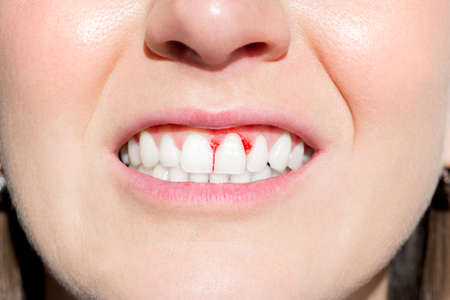 Bleeding Gums: What You Should Know